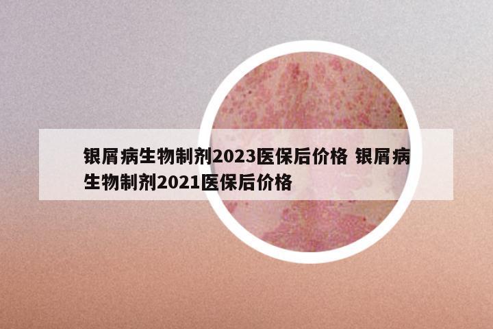 银屑病生物制剂2023医保后价格 银屑病生物制剂2021医保后价格