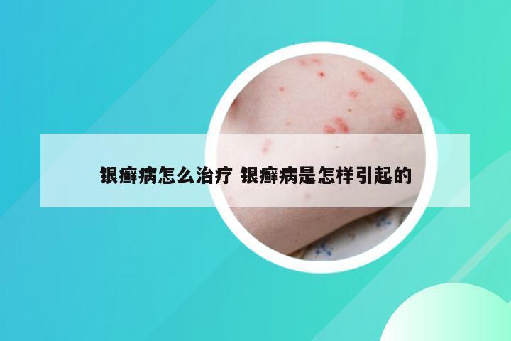 银癣病怎么治疗 银癣病是怎样引起的