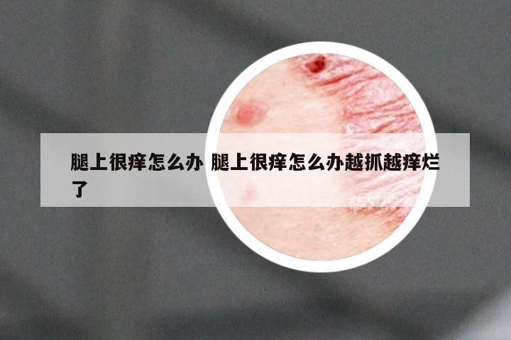 腿上很痒怎么办 腿上很痒怎么办越抓越痒烂了