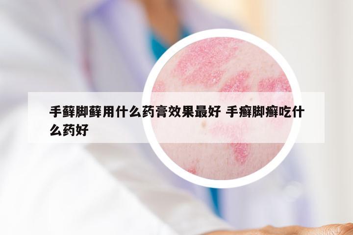 手藓脚藓用什么药膏效果最好 手癣脚癣吃什么药好