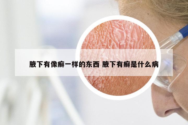 腋下有像癣一样的东西 腋下有癣是什么病