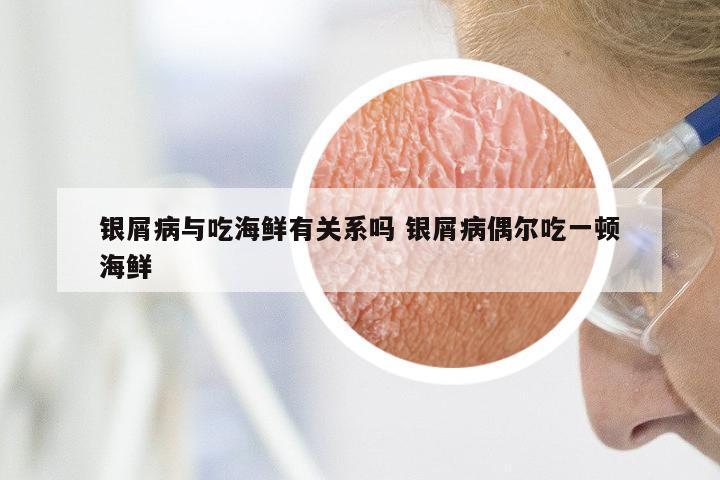 银屑病与吃海鲜有关系吗 银屑病偶尔吃一顿海鲜