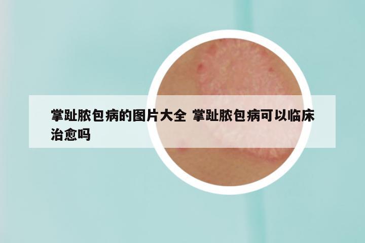 掌趾脓包病的图片大全 掌趾脓包病可以临床治愈吗