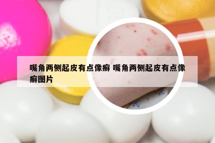 嘴角两侧起皮有点像癣 嘴角两侧起皮有点像癣图片