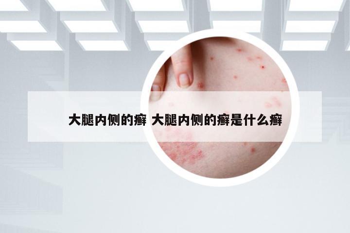 大腿内侧的癣 大腿内侧的癣是什么癣