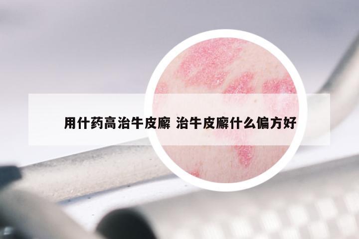 用什药高治牛皮廨 治牛皮廨什么偏方好