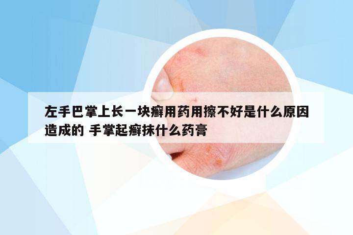 左手巴掌上长一块癣用药用擦不好是什么原因造成的 手掌起癣抹什么药膏