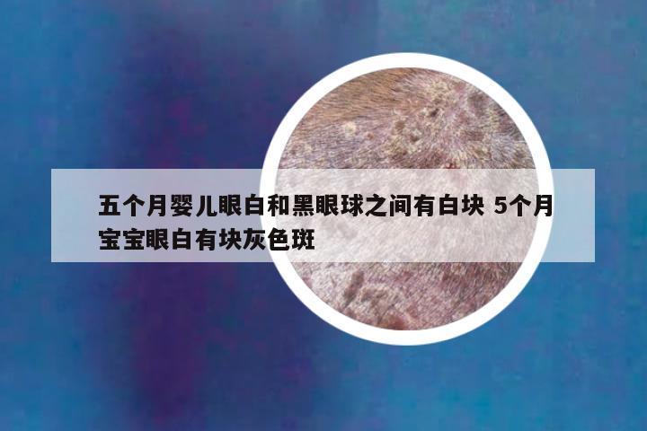 五个月婴儿眼白和黑眼球之间有白块 5个月宝宝眼白有块灰色斑