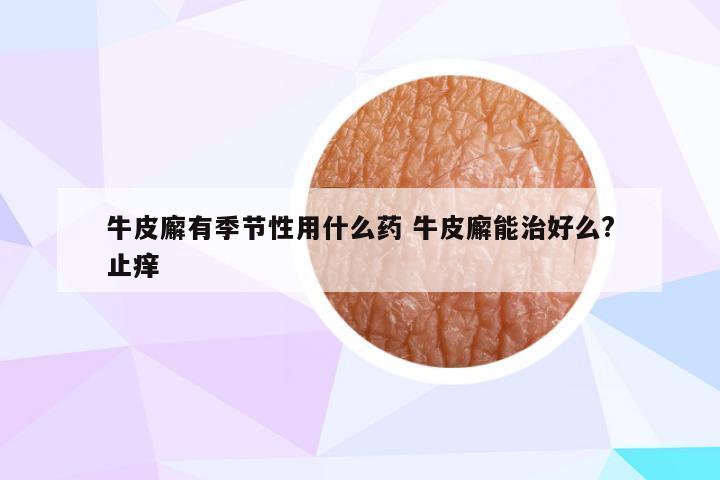 牛皮廨有季节性用什么药 牛皮廨能治好么?止痒