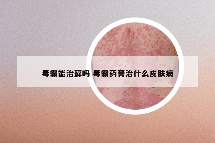 毒霸能治藓吗 毒霸药膏治什么皮肤病