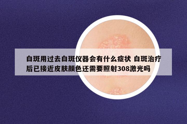 白斑用过去白斑仪器会有什么症状 白斑治疗后已接近皮肤颜色还需要照射308激光吗