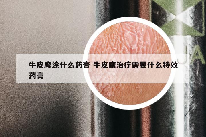 牛皮廨涂什么药膏 牛皮廨治疗需要什么特效药膏