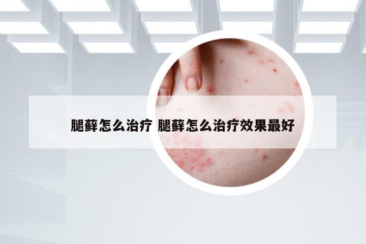 腿藓怎么治疗 腿藓怎么治疗效果最好