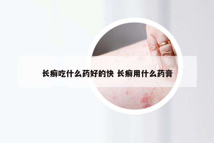 长癣吃什么药好的快 长癣用什么药膏