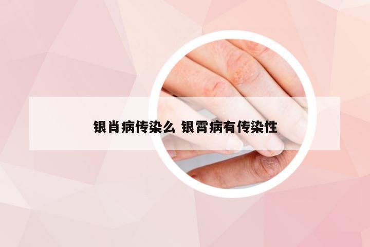 银肖病传染么 银霄病有传染性