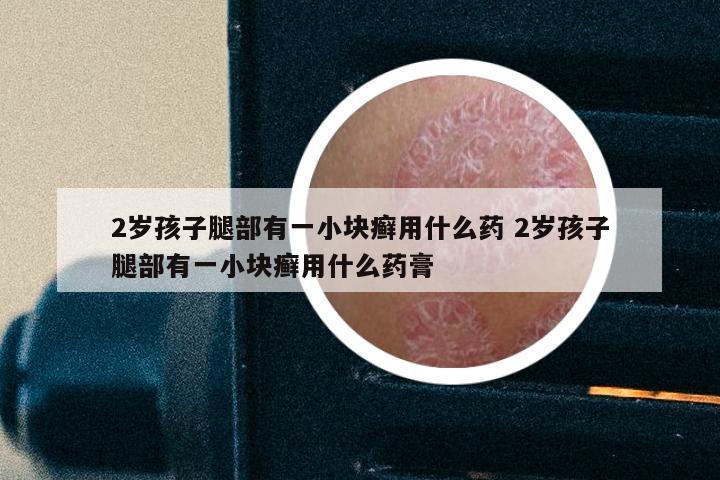 2岁孩子腿部有一小块癣用什么药 2岁孩子腿部有一小块癣用什么药膏