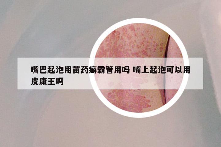 嘴巴起泡用苗药癣霸管用吗 嘴上起泡可以用皮康王吗