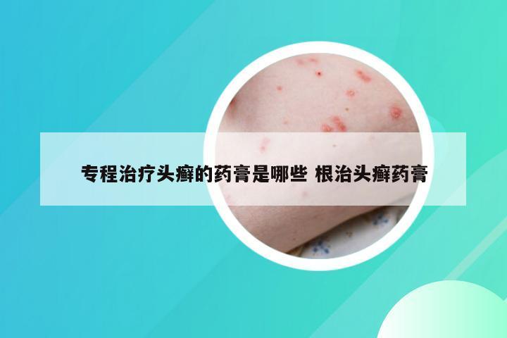 专程治疗头癣的药膏是哪些 根治头癣药膏