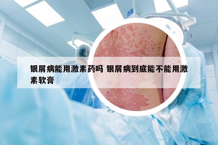 银屑病能用激素药吗 银屑病到底能不能用激素软膏