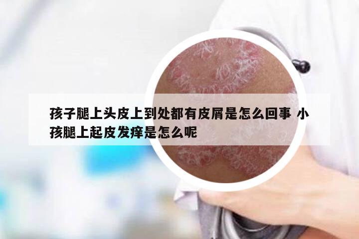 孩子腿上头皮上到处都有皮屑是怎么回事 小孩腿上起皮发痒是怎么呢