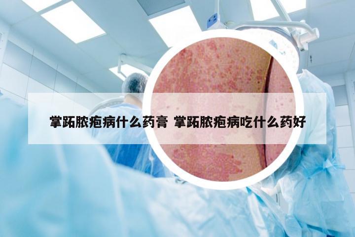 掌跖脓疱病什么药膏 掌跖脓疱病吃什么药好