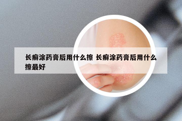 长癣涂药膏后用什么擦 长癣涂药膏后用什么擦最好