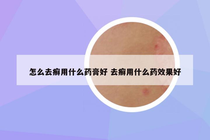 怎么去癣用什么药膏好 去癣用什么药效果好