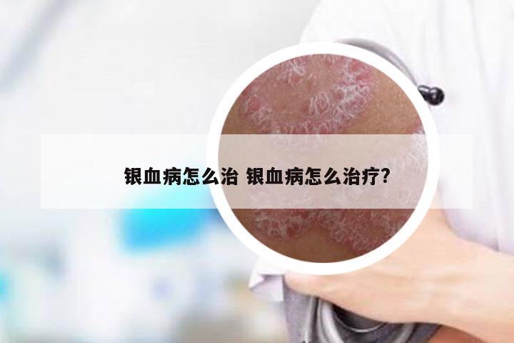 银血病怎么治 银血病怎么治疗?