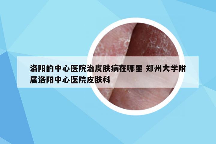 洛阳的中心医院治皮肤病在哪里 郑州大学附属洛阳中心医院皮肤科