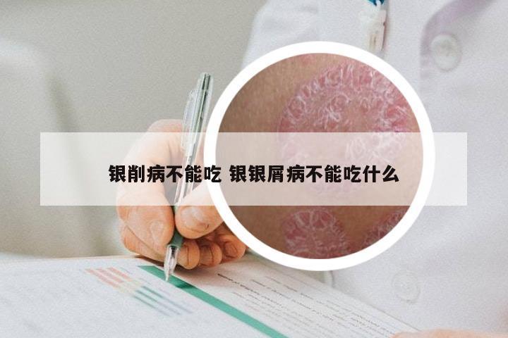 银削病不能吃 银银屑病不能吃什么