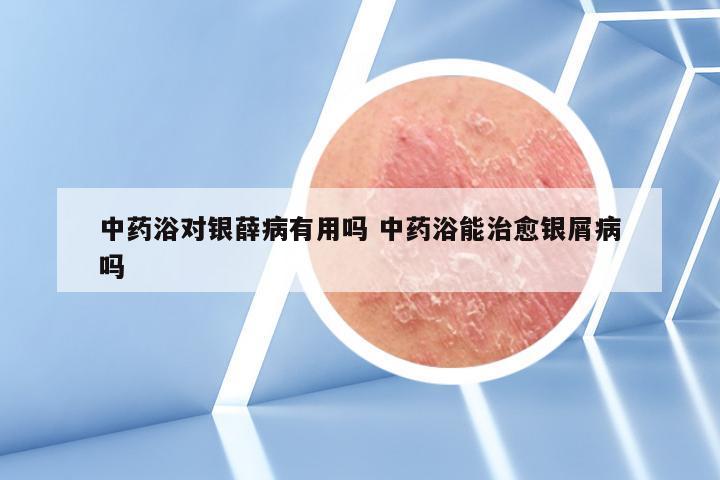 中药浴对银薛病有用吗 中药浴能治愈银屑病吗