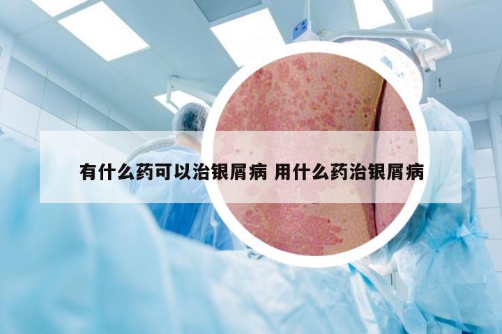 有什么药可以治银屑病 用什么药治银屑病