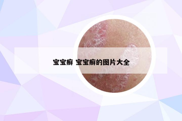 宝宝癣 宝宝癣的图片大全