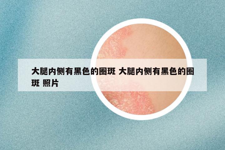 大腿内侧有黑色的圈斑 大腿内侧有黑色的圈斑 照片