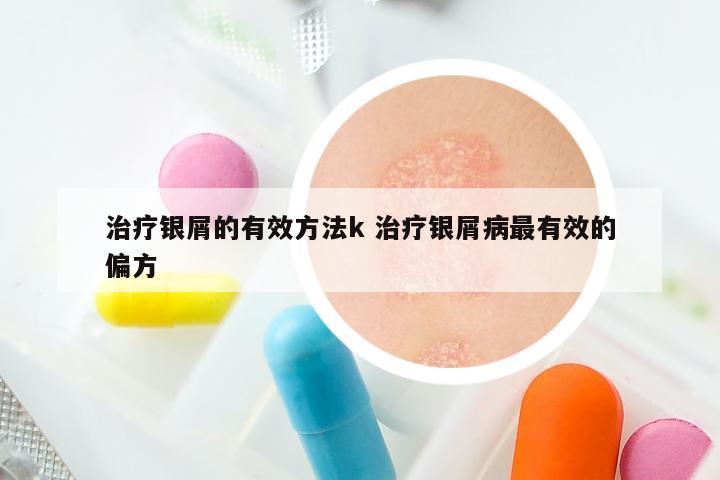 治疗银屑的有效方法k 治疗银屑病最有效的偏方