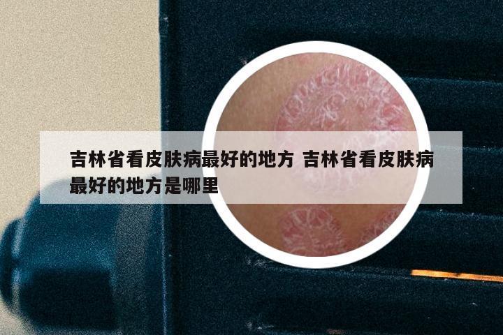 吉林省看皮肤病最好的地方 吉林省看皮肤病最好的地方是哪里