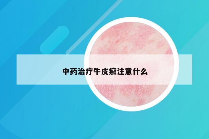 中药治疗牛皮癣注意什么