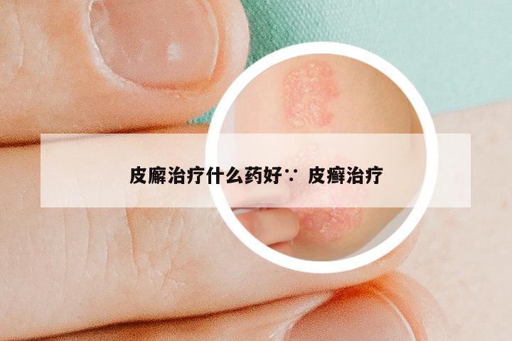 皮廨治疗什么药好∵ 皮癣治疗