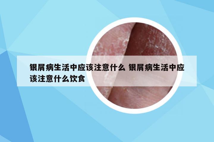 银屑病生活中应该注意什么 银屑病生活中应该注意什么饮食