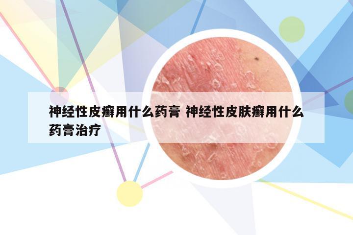 神经性皮癣用什么药膏 神经性皮肤癣用什么药膏治疗