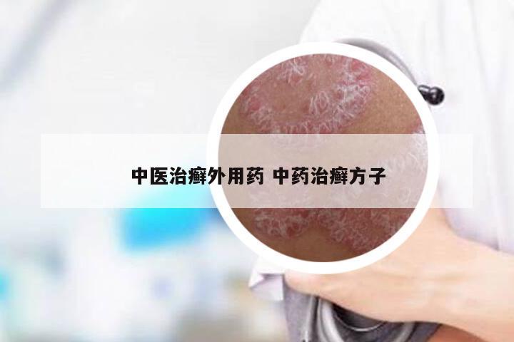 中医治癣外用药 中药治癣方子