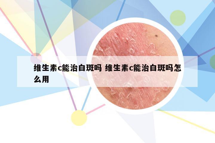 维生素c能治白斑吗 维生素c能治白斑吗怎么用