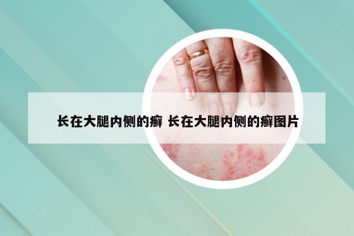 长在大腿内侧的癣 长在大腿内侧的癣图片