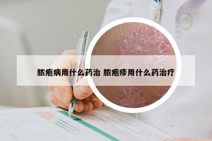 脓疱病用什么药治 脓疱疹用什么药治疗