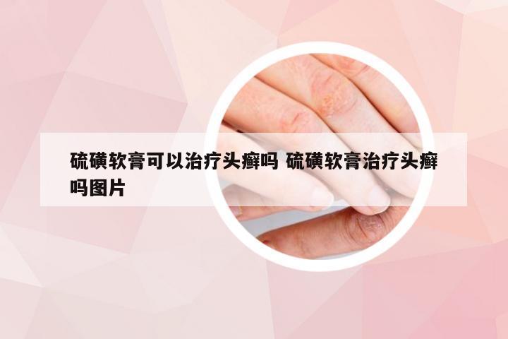 硫磺软膏可以治疗头癣吗 硫磺软膏治疗头癣吗图片