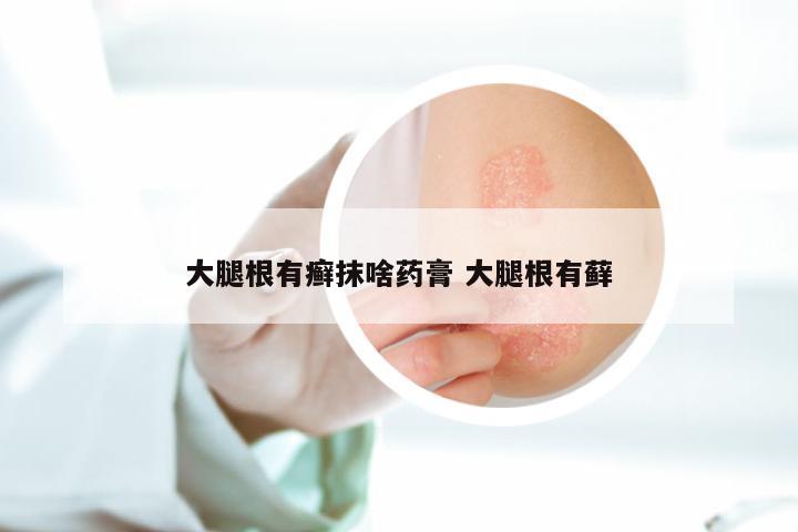 大腿根有癣抹啥药膏 大腿根有藓