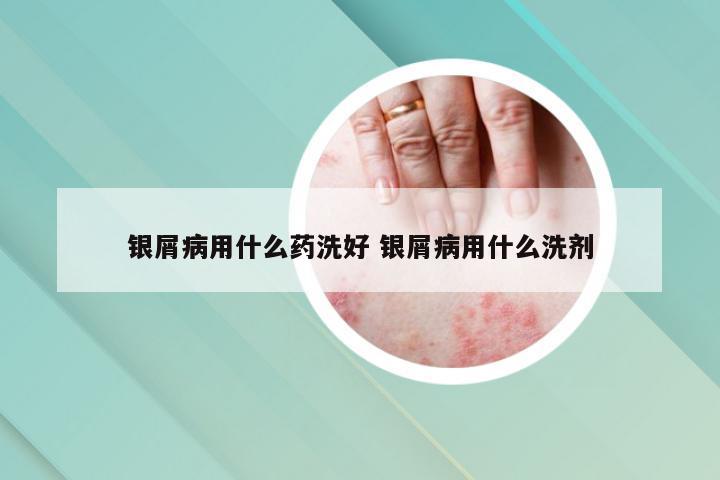 银屑病用什么药洗好 银屑病用什么洗剂