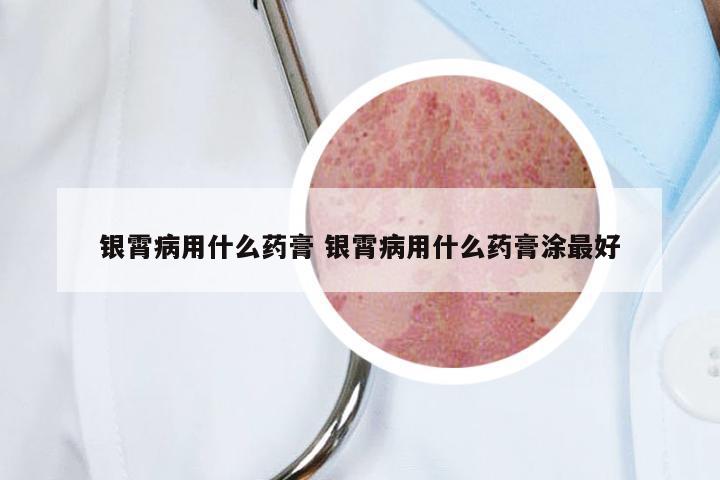 银霄病用什么药膏 银霄病用什么药膏涂最好