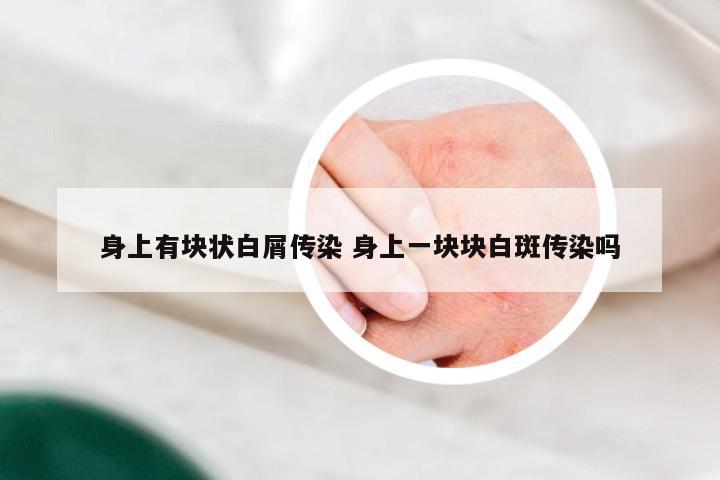 身上有块状白屑传染 身上一块块白斑传染吗