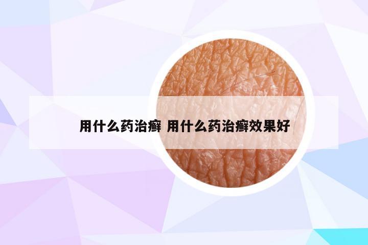 用什么药治癣 用什么药治癣效果好